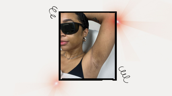 Image of beauty writer Aimee Simeon undergoing laser hair removal